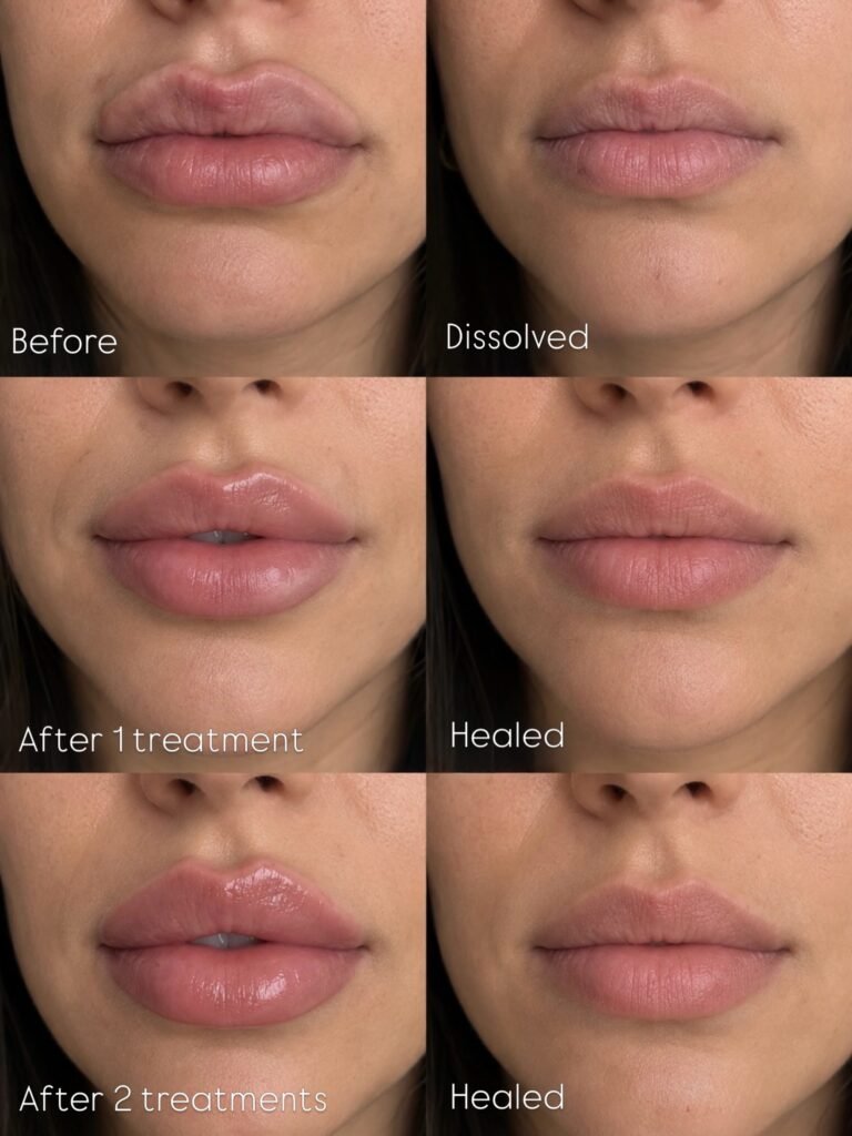 Lips dissolved then rebuilt over two treatments at SKN MD