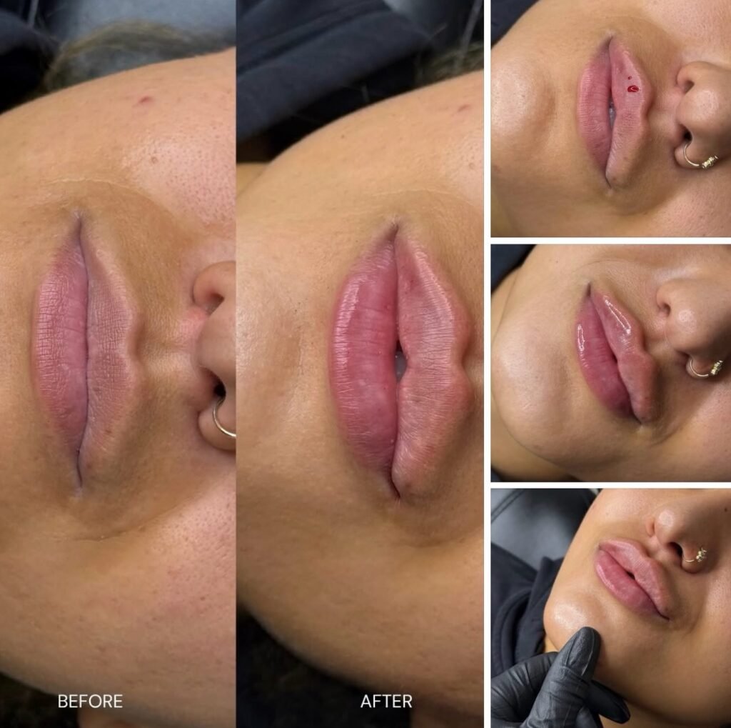 Subtle lip enhancement for better balance at SKN MD, before and after